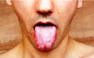 जीभ पर जमी सफेद गंदी परत होती है बीमारी की निशानी, इन तरीकों से 2 मिनट में करें सफाई