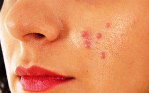 अगर आप भी हैं Blind Pimples से परेशान तो अपनाएं ये पांच आसान तरीके