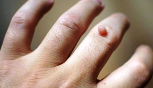 मस्सों की समस्या से पाना है छुटकारा तो ऐसे करें अलसी का इस्तेमाल, कुछ ही दिनों में दिखेगा असर