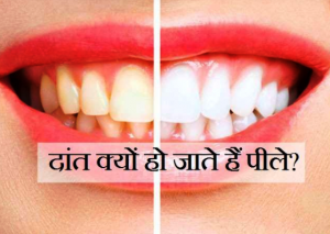Yellow Teeth Remedies: जानें दांत क्यों हो जाते हैं पीले, ऐसे करें इनका इलाज!