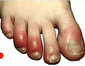 सर्दियों में आपके पैरों की उंगलियों में भी आ जाती है सूजन, करें ये काम तुरंत मिलेगी राहत