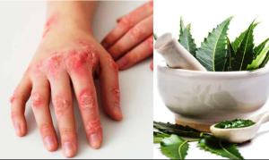 दाद, खाज, खुजली से हैं परेशान, नीम के तेल से होगा इनका सफाया, ऐसे करें इस्तेमाल