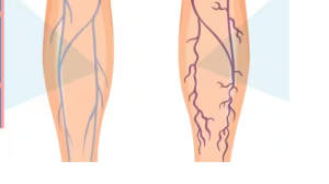 पैरों पर नीली नसों का दिखना गंभीर बीमारी के हैं लक्षण!