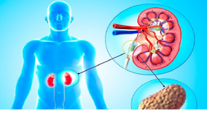 इन चीजों का अधिक सेवन करते हैं तो हो सकती है पथरी, बचाव के लिए इन बातों को जानना जरूरी