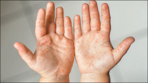 मध्य प्रदेश में खसरे से 2 बच्चों की मौत, तेजी से पैर पसार रही है बीमारी, जान लें लक्षण और बचाव के तरीके