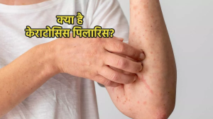 क्या है स्किन से जुड़ी केराटोसिस पिलारिस की समस्या? जिसमें शरीर पर नजर आते हैं मोटे-मोटे दाने