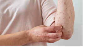 मध्‍यप्रदेश में खसरे से दो बच्चों की मौत 17 संक्रमित, तेजी से बच्चों की बीच फैल रही है ये बीमारी...जानें इसके लक्षण