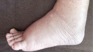 वॉटर रिटेंशन की वजह से फूलने लगती है बॉडी, अंगों में जमने लगता है पानी; जानें कैसे करें कंट्रोल?