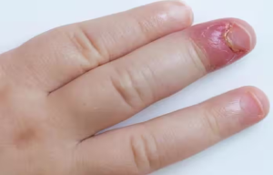 क्यों होता है बच्चों में Fungal Nail Infection? जानें कारण और बचाव के उपाय