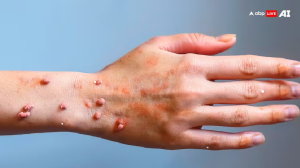 M-Pox Symptoms: पाकिस्तान में भी आया मंकीपॉक्स का केस... जानें कितनी तेजी से फैलती है ये बीमारी, बच्चों के लिए कितनी खतरनाक