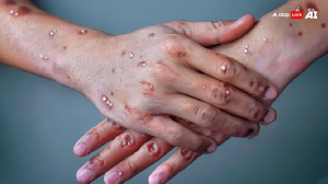 Monkey Pox: मंकीपॉक्स होने पर भूलकर भी न करें ये चीजें, जिंदगीभर होगा पछतावा साथ ही जानें कैसे दिखते हैं इसके दाने