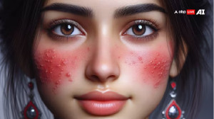 Slapped Cheek Virus: क्या बला है स्लैप्ड चीक्स वायरस, गालों पर क्यों हो जाते हैं छोटे-छोटे दाने?