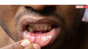 Mouth Ulcers: बार-बार मुंह में छाले हो जाते हैं? तो इन गंभीर बीमारियों के हैं शुरुआती संकेत